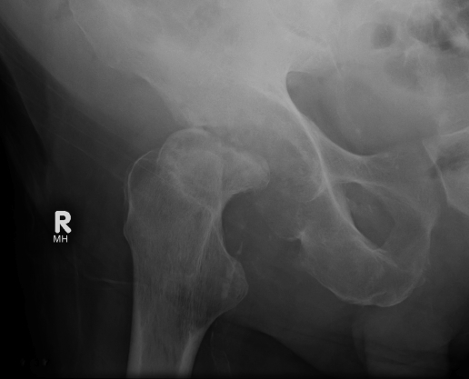 Hip Septic Arthritis